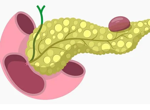 Pancreatic Cyst consultation at Niraaya Hospital